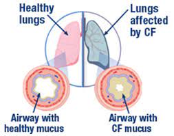 What Is Cystic Fibrosis Cf Pulmozyme Dornase Alfa Cystic Fibrosis Cystic Fibrosis Awareness Nursing School Survival