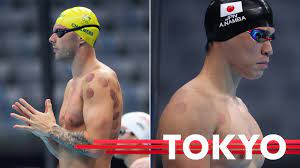 It seems that cupping is having a comeback, and one does not need to be a clairvoyant to predict that, after the olympic games, cupping will become flavour of the month. Tokyo 2020 Olympics Cupping Therapy Reason For Swimmers Weird Spots During Olympic Games Verve Times