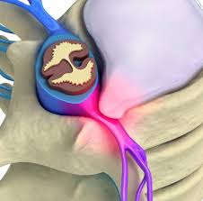 We did not find results for: How To Safely Lift And Do Yoga When You Have A Bulging Disc Breaking Muscle