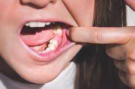 Image result for Tooth Extraction