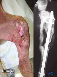 Image result for Fracture Complication