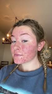 Clearing Acne Scars: Month 2 Update