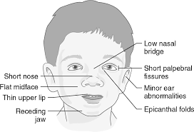 Epicanthic fold , also called epicanthal fold , fold of skin across the inner corner of the eye (canthus). Down Syndrome Nose Is Small With The Flat Nasal Bridge Page 1 Line 17qq Com