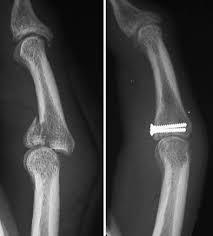 Image result for Lateral PIP Dislocation