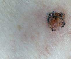Recently, the centers for disease control and prevention (cdc). Under Their Skin The Morgellons Mystery