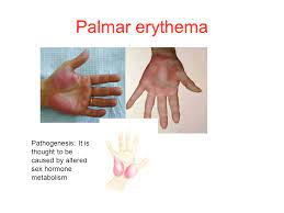 The first question you may have is, what is palmar erythema? as mentioned, it is a reddening of the palms. The Cirrhosis Tsunami Are We Ready Ppt Video Online Download