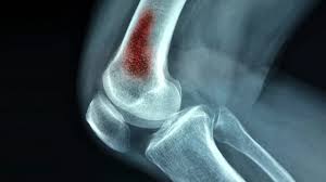 Osteomyelitis Johns Hopkins Medicine