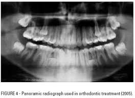 Use Of Orthodontic Records In Human Identification