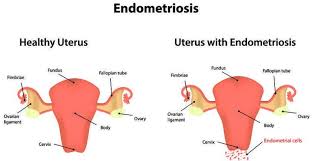 Badan cepat lelah salah satu tanda sakit ginjal adalah cepat lelah. Sakit Perut Belah Kanan Appendisitis Atau Bukan Ini Perkara Penting Yang Anda Kena Tahu