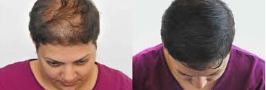 Le cancer colorectal se développe à partir des cellules qui tapissent l'intérieur du côlon ou du rectum. Tricopigmentation Capillaire Micropigmentation A Bruxelles A Woluwe Saint Lambert Centre Jacqueline Van Leeuw