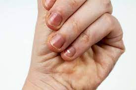 Infecciones Por Hongos Farmaceuticonline