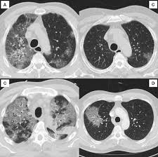 Covid 19 Radiology Reference Article Radiopaedia Org