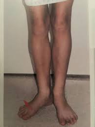 Image result for Femoral Retroversion