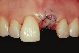 Tooth extraction does not need to scare baby teeth and other teeth that could be loose due to issues of gum disease are normally easiest to pull out. The Soft Tissue Graft Placed Atop The Bone Graft And Stabilized By Six Download Scientific Diagram