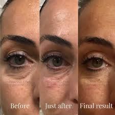 My panic attacks have been really bad recently so i realize i should let it build up in my system for the i take 1mg of kolonipin as needed i have ptsd and bipolar disorder my panic attacks are very bad my question is how long does it take to kick in please. Tear Trough Fillers A Solution To Dark Circles Eye Bags Hollows