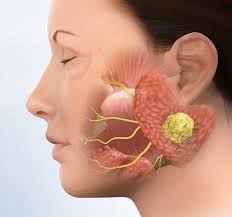 Parotid gland surgery