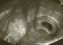 Wann funktioniert ein schwangerschaftstest und ab wann ist der gebrauch sinnvoll? Ab Wann Kann Ein Arzt Eine Schwangerschaft Per Ultraschall Sehen Angst Schwanger Baby