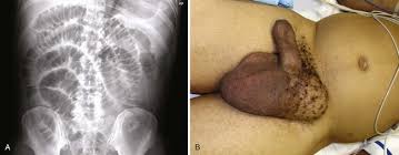 Image result for Hernia Reduction