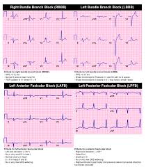 Image result for Right Bundle Branch Block