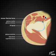 Iliotibial Band Itb Anatomy Diagrams Radiology Case Radiopaedia Org Iliotibial Band Radiology It Band