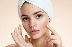 Check spelling or type a new query. 18 Acne Ideas Acne Acne Treatment Acne Remedies