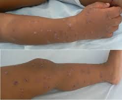 Image result for Papular Acrodermatitis