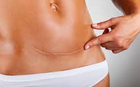 Acute blindedarmontsteking de arts heeft vastgesteld dat u een acute blindedarmontsteking heeft. Laathetlos Nu Massagetherapie In Breda Posts Facebook