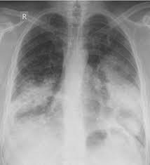 Learn more about lung cancer symptoms in women. Lung Cancer Knowledge Amboss