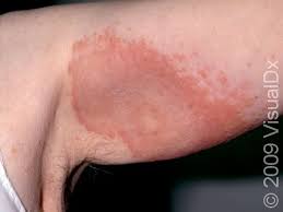 Image result for contact dermatitis