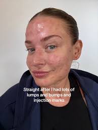 Hyaluronic Acid Serum Result