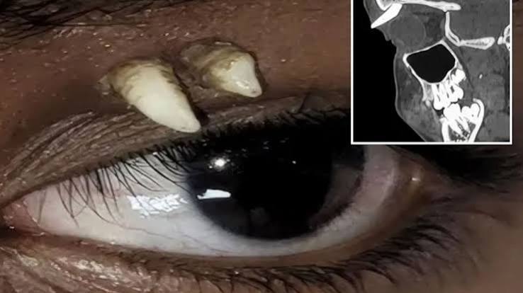 Boy, 16, stuns doctors with TOOTH growing out of his eye socket - in first case of bizarre condition