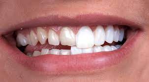 Veneers | Manhattan | NYC Center for Dental Implants