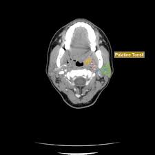 Image result for tonsilla palatina
