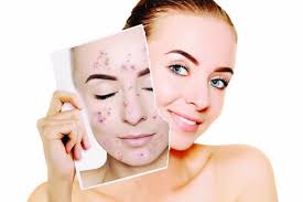 Tackling Teenage Acne