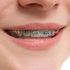 Your orthodontist will carefully thread the archwire into the bands and then align them into the freshly attached brackets, removing any excess wire so that you will not get poked. 3 Things You Might Not Know About Moving Teeth Schwenksville Dental Care