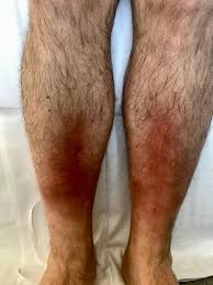 Image result for erythema nodosum
