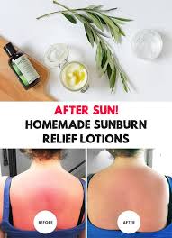 After Sun Homemade Sunburn Relief Lotions Sunburn Relief Soothing Lotion Sunburn Remedies