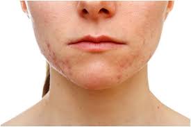 Chin Acne What Is It Causes And How To Get Rid Of It Chin Acne Acne Causes Pimples On Chin