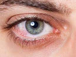 Das menschliche auge ist ein kugelförmiger körper, der auch als augapfel bezeichnet wird. Gerotete Augen Ursachen Linderung Bepanthen