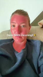 Fruit of The Earth Aloe Vera Gel Sunburn