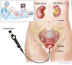Transitional Cell Cancer Of The Renal Pelvis And Ureter Treatment Pdq Patient Version National Cancer Institute