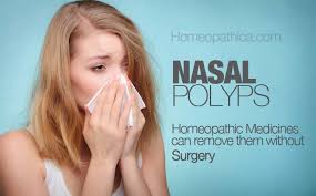 So, a corticosteroid spray may be continued to prevent the nasal polyps from returning and undergo periodic medical examinations with a nasal endoscope. Nasal Polyps 6 Best Homeopathic Medicines For Removing Them Homeopathica