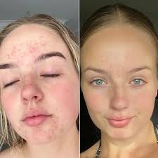 Skin needling: Samantha Appel opens fifth The Skin Bar clinic in Sydney