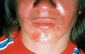 The herpes simplex viruses are both similar and different and are often misunderstood. Herpes Simplex Signs And Symptoms