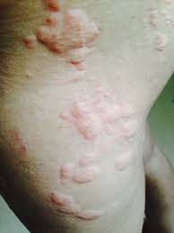 Kami kongsikan kepada anda, petua untuk menghilangkan gatal batang keladi. 9 Petua Berkesan Hilangkan Gegata Pada Badan Anda