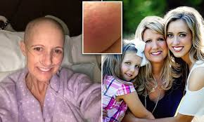 Early detection of breast cancer is the key to survival. Texas Mom S Skin Rash Was Terminal Breast Cancer Daily Mail Online