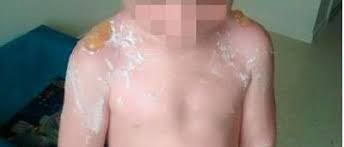 Un coup de soleil peut s'attraper même sans faire la crêpe ! D Enormes Coups De Soleil Font Souffrir Cet Enfant Il A Meme Une Enorme Cloque Dans Le Dos Photos Sudinfo Be