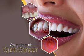 Image result for gums cancer symptoms