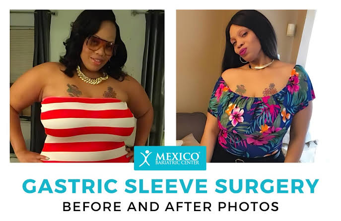 Gastric Sleeve Before and After Photos: Best Pictures of 2026