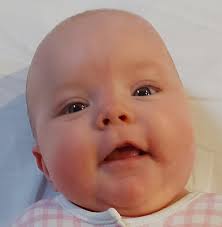 Stork mark/ angel kiss